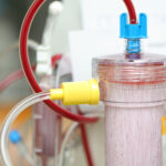 Part of a dialysis equipment during process of blood filtration